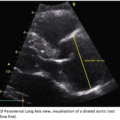 September 2021 -  Diagnosing Thoracic Aortic Dissection using Bedside Ultrasound in an Emergency Department in a Norwegian University Teaching Hospital